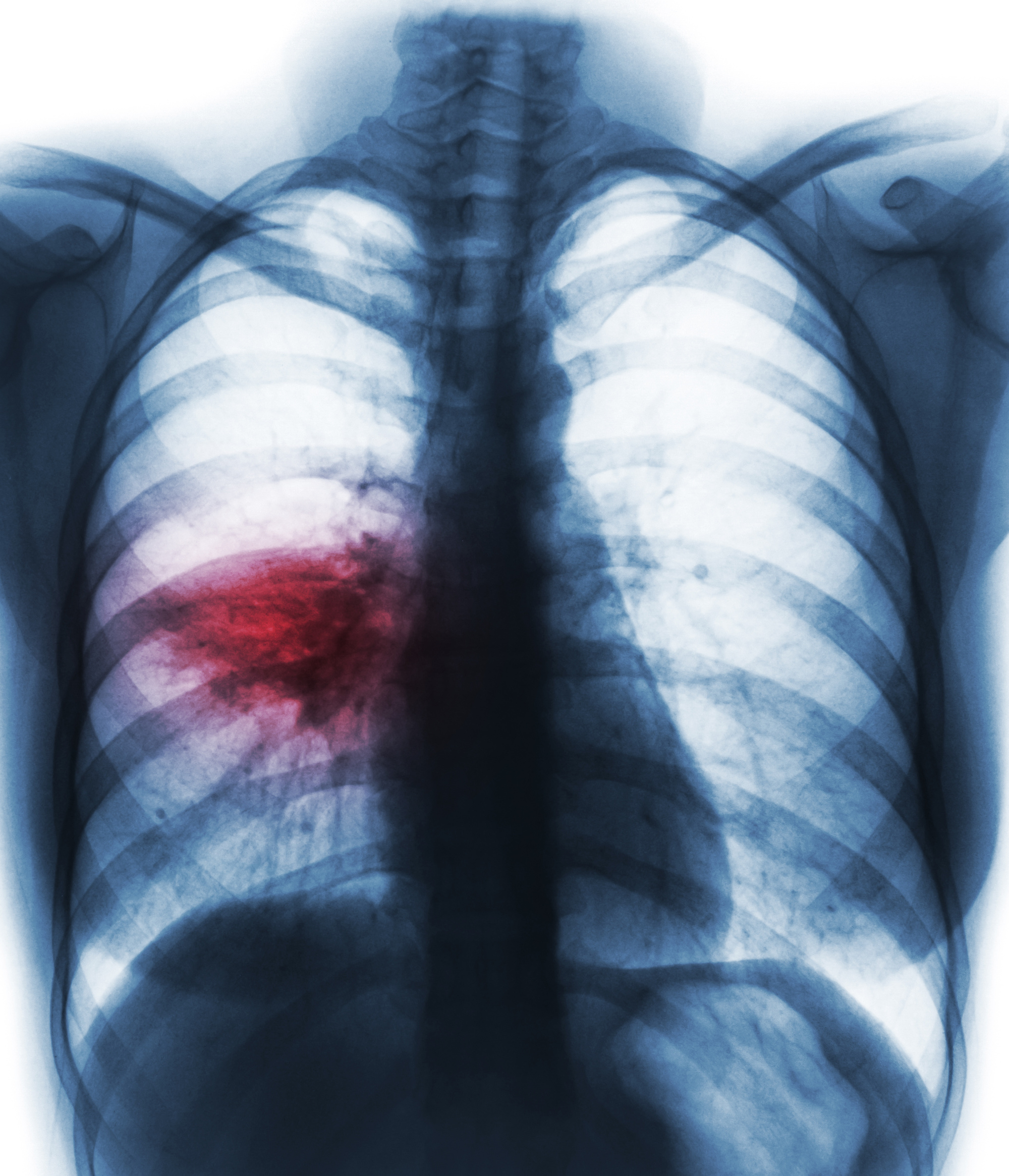 Anhaltender Erkältungshusten / Bronchitis / Lungenentzündung / wiederholte Asthmaanfälle / Krankenhausaufenthalt wegen Atemnot / Krebs der Atemwege / festsitzende Arthrose, Arthritis / Ekzeme, Juckreiz